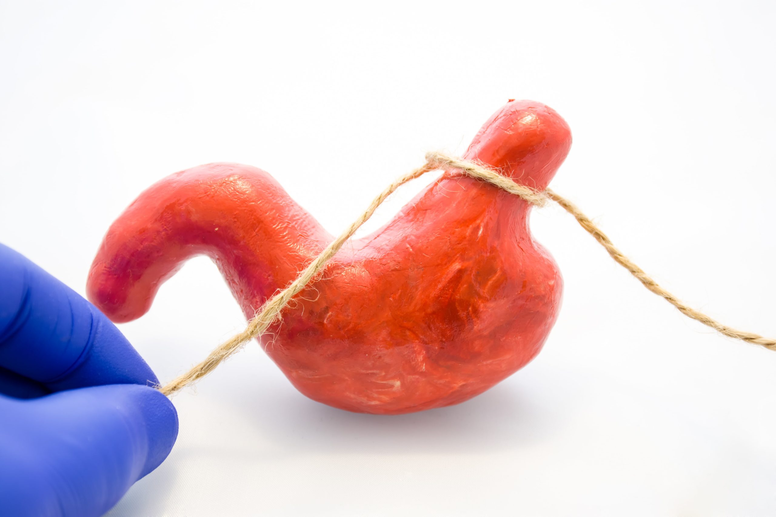 Cirurgia bariátrica